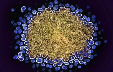 Mutations in the gene that encodes a receptor called CCR5 can stop HIV (blue) entering immune cells.Credit: NIAID/National Institutes of Health/SPL