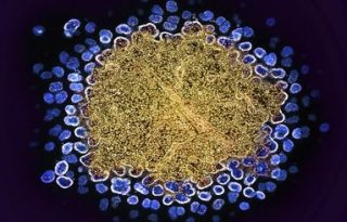 Mutations in the gene that encodes a receptor called CCR5 can stop HIV (blue) entering immune cells.Credit: NIAID/National Institutes of Health/SPL